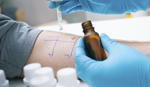 Doctor performing allergy tests on patient