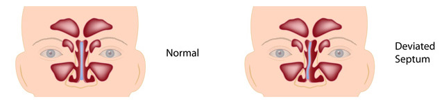 example of a normal septum and a deviated one