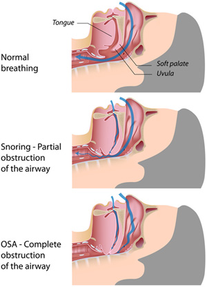 Example of normal breathing vs not normal breathing while sleeping