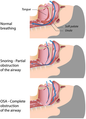 Sleep Apnea Mouth Guard, Mouthguard for Sleeping